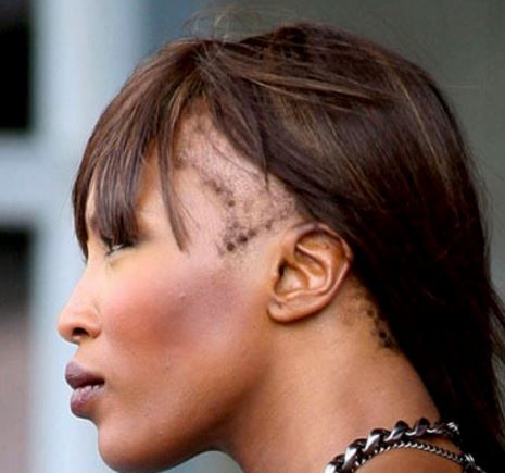 13 Best & Worst Female Hairstyles For A Receding Hairline - Wimpole Clinic