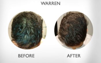 DOES REGROWZ NATURAL HAIR TREAMENT REALLY WORK FOR MEN HAIR LOSS AND RECEEDING HAIRLINE?